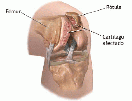 Condromalacia Rotuliana: Cuando el dolor de rodilla empieza en tu intestino